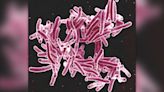 2nd tuberculosis outbreak linked to bone grafts in the US