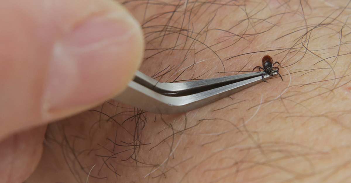 The Best Way to Remove a Tick? Use This Two-Sided Tool