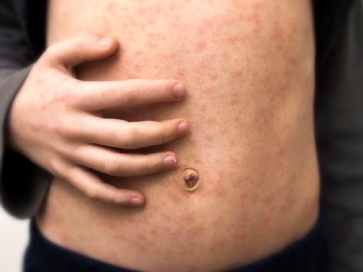 Measles cases have been reported in 19 states this year. What does a measles rash look like?