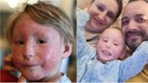Toddler with eczema so bad liquid was 'pouring from his face' receives life-changing treatment