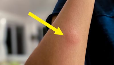 Experts Are Sharing The One Crucial Mistake You Should Absolutely Avoid With Mosquito Bites