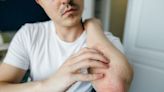 Early Signs and Symptoms of Psoriasis