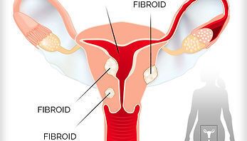 Ascend Pain and Wellness Introduces Uterine Fibroid Treatment Without Surgery