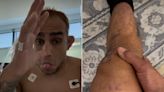 Tony Ferguson says he fought Paddy Pimblett with torn MCL at UFC 296, reveals recent surgery