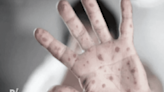 S.Korea reports 1st suspected monkeypox cases￼ - Dimsum Daily