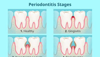 Periodontitis: Early Symptoms and Advanced Gum Disease