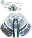 Weber's syndrome