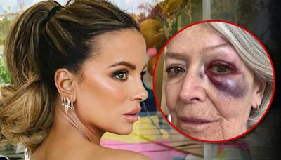 Kate Beckinsale Sparks Concern After Posting Photo of Mom with Bruised Eye