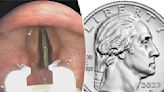 Teen gets quarter stuck in throat during ill-advised stunt — even doctors were shocked