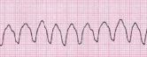 Ventricular tachycardia