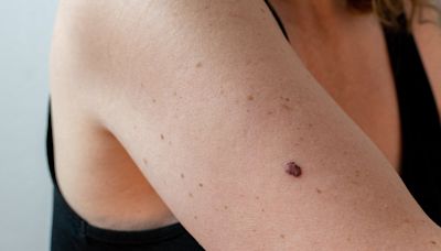 3 Types of Skin Cancer That Should Be on Everyone's Radar