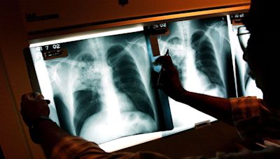 California Tuberculosis outbreak kills 1, infects 14 as officials declare health emergency