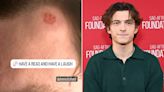 Tom Holland Shares Image of Painful Head Injury from Family Golf Day: ‘You Can Almost See the Dimples’