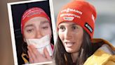 „Wenn schon scheiße, dann wohl richtig” - Deutscher Biathletin Juliane Frühwirt muss nach Horrorunfall Zunge transplantiert werden