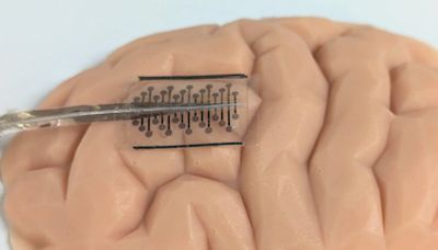 Folding implants that expand in the brain ‘could make epilepsy surgeries safer’