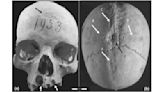 Painful 'cross-shaped incision' in medieval woman's skull didn't kill her, but second surgery did