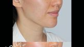 ¿Sueñas con un “Face lift” sin cirugía? Este tratamiento revolucionario es para ti...¡Mira las fotos!