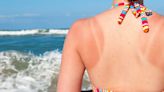 Does Your Sunburn Require Medical Attention? Here Are The 2 Signs It Does