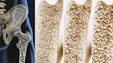 Cuál es la proteína que podría fortalecer los huesos y prevenir la osteoporosis