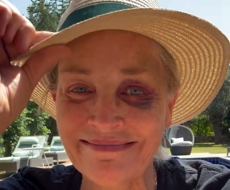 Sharon Stone reveals how she got a black eye on vacation in Turkey