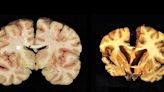 Brain study reveals 41% of young athletes under 30 had signs of CTE