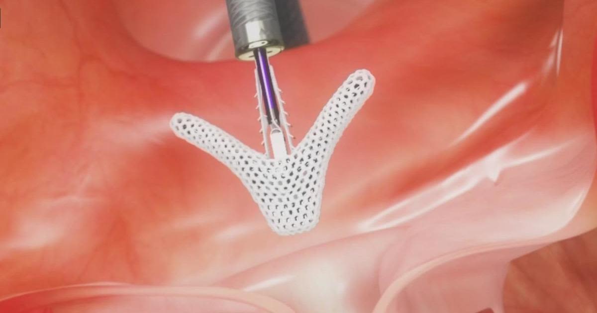 New device at UC Davis helps avoid open heart surgery. Here's how it works