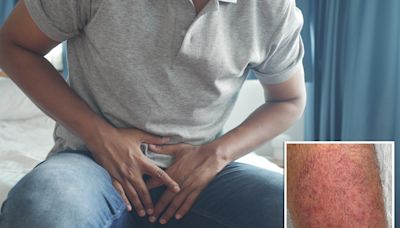 New, contagious fungal infection found in NYC after patient reported groin lesions – here’s how to keep yourself safe