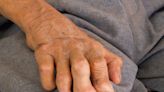 Why is leprosy spreading in Florida? What to know about recent rise in US cases