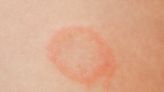 Highly contagious form of sexually transmitted ringworm reported in the US for the 1st time