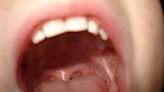 蛀牙抽神經沒做「這事」！他舌頭「鋸齒狀破皮」2個月 一查竟是癌症…醫嘆：轉移率超高