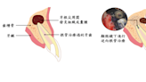 微創逆向根管治療 不再牙痛