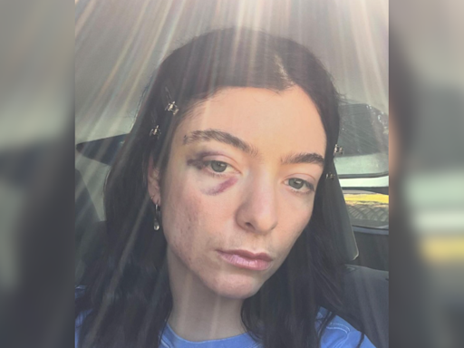 Lorde fans express concern after singer shares selfie with black eye