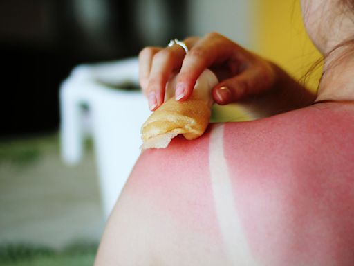 "It's A Bad Sign": How To Know If Your Sunburn Needs Medical Attention, According To Doctors