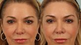 What’s the difference between these two cosmetic treatments, Sculptra and Voluma?