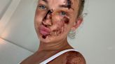 Holiday warning as Brit shows off injuries after bike crash on Greek isle