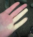 Raynaud syndrome