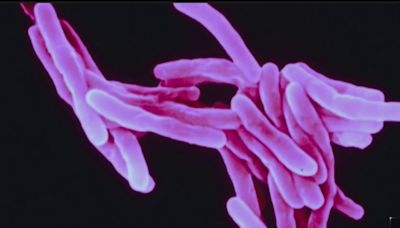 Tuberculosis tracking in San Diego County leads to College of Continuing Education