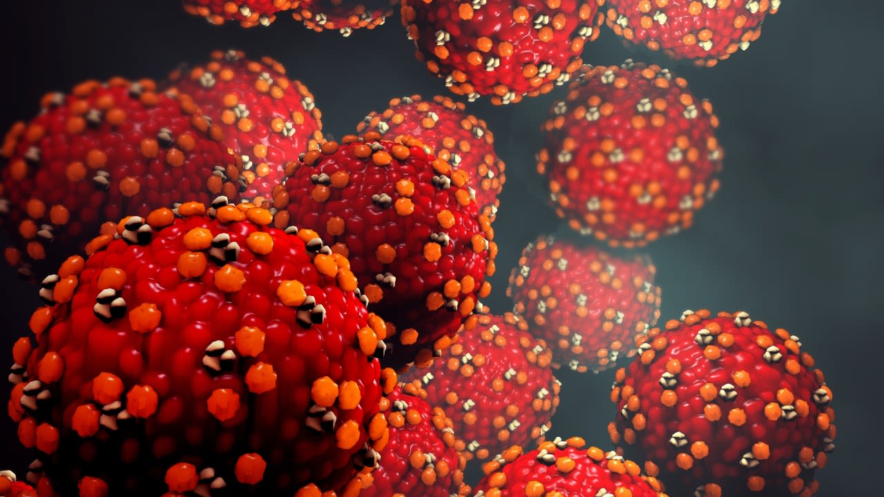 Wisconsin DHS: Measles case confirmed in Dane County resident