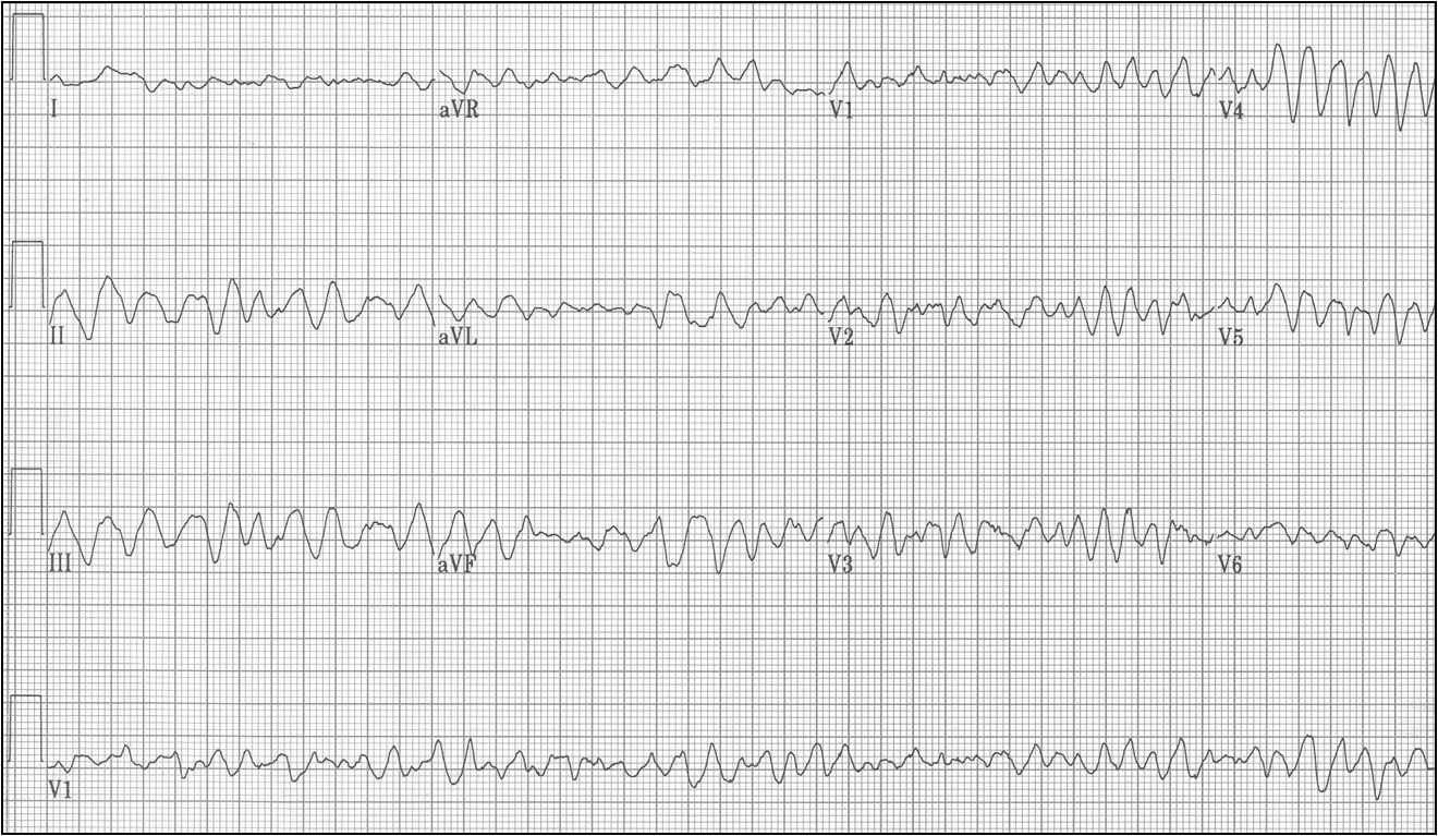 ECG Learning Center - An introduction to clinical electrocardiography