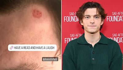 Tom Holland Shares Image of Painful Head Injury from Family Golf Day: ‘You Can Almost See the Dimples’