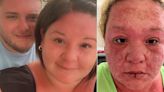 I was on my dream holiday – then my skin started falling off
