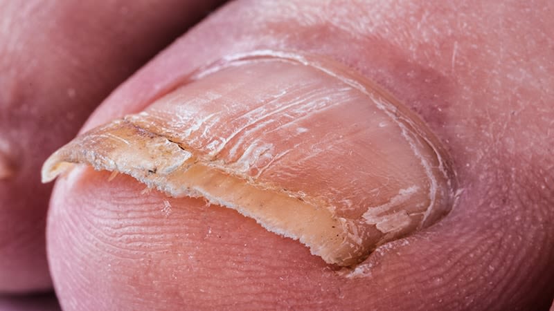 Study Identifies Several Onychomycosis Risk Factors