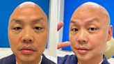 Makeup Artist Daniel Martin Shares Plastic Surgery Journey in Hopes of Breaking Stigma for Men (Exclusive)