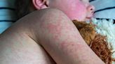 Measles cases worldwide almost double in a year - as England faces measles 'emergency'
