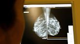 Breast cancer screening should begin at age 40, US panel says