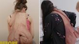 Watch transformation of woman whose 'hazelnut' lump grew into 'cape-like' tumour