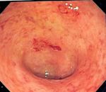 Ulcerative colitis