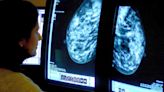 AI tool outperforms experts in spotting breast cancer, says new study
