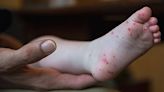 Dozens of Duke students diagnosed with hand, foot and mouth disease in recent weeks