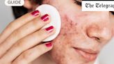 How to treat adult acne: causes, treatments and steps to prevent it